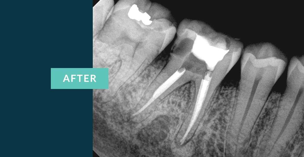 Root Canal Root Canal Molar Root Canals