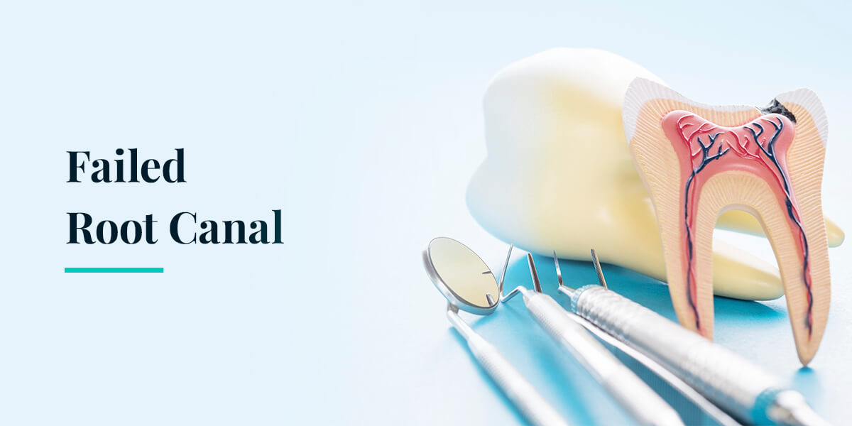 Root Canal Treatment: Meaning and Process