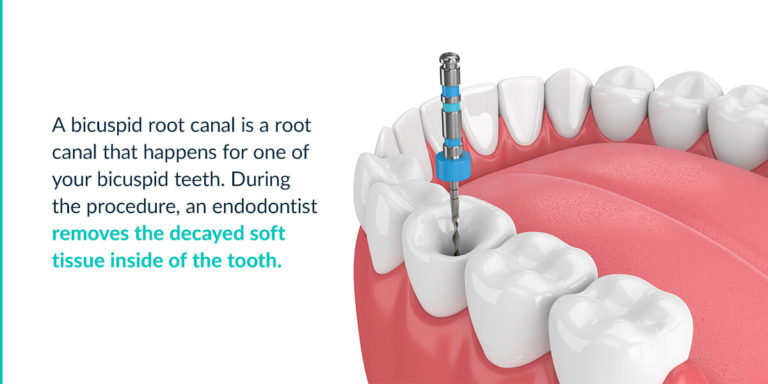 Root Canal Bicuspid - What Is a Bicuspid Tooth? | MENYC