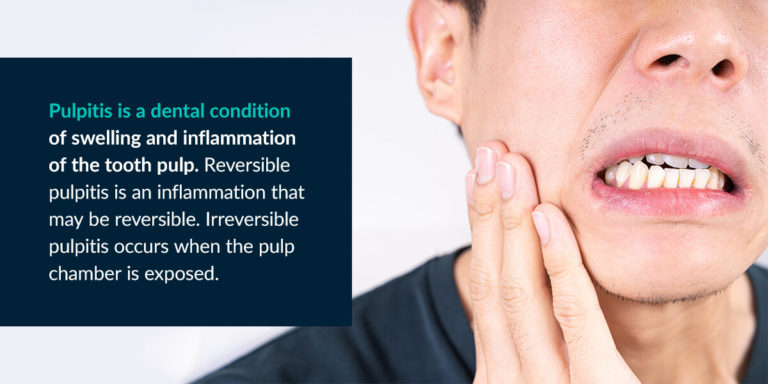 What Causes An Infected Tooth Pulp? | Midtown Endodontist NYC